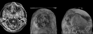 Rendering del volumen de piel y músculo con raycasting / Muscle and Skin Volume Rendering with raycasting